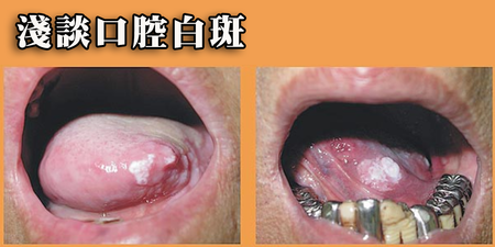 口腔出現白斑是潰瘍還是癌症？　醫師指出三種病灶為「口腔癌」警訊