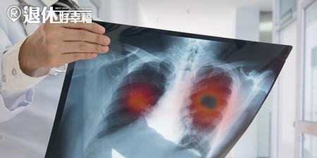 低劑量電腦掃描，揪出初期肺癌