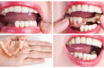 假牙還是有可能蛀牙、得牙周病？補綴科醫師釐清三大錯誤觀念