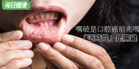 口腔癌4大早期症狀大揭密？「嘴破」整個月要小心