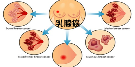 惡性腫瘤中發病率第二名的『乳腺癌 』—兩大早期症狀，一旦發現馬上治療，守護雙峰不求人！