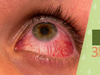 明目、補肝腎：郭大維狂推護眼8穴有效預防乾眼症