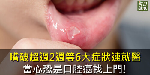 嘴破超過2週等6大症狀速就醫　當心恐是口腔癌找上門！