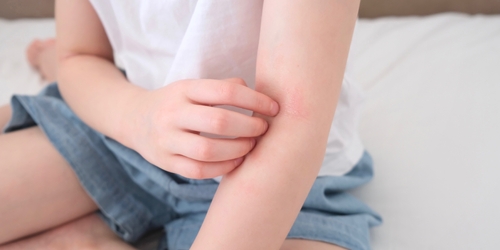 小兒濕疹、接觸性皮炎一次看　2招防治皮膚瘙癢