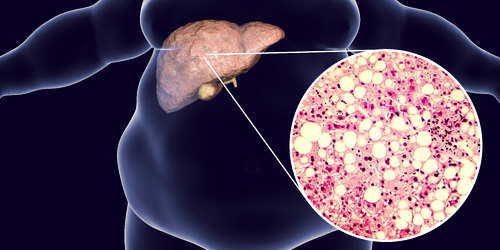 肝癌每年帶走近8千人　專家示警：「肥胖」罹癌機率高普通人1.8倍