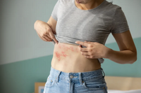 生活壓力大恐增皮蛇風險！?　新竹人請注意