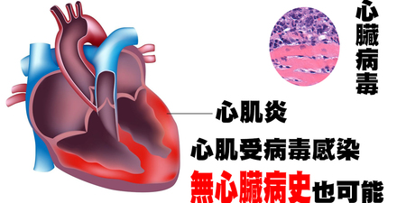 無心臟病史也危險！病毒性心臟病「心肌炎」成因與「九種徵兆」！｜每日健康Health