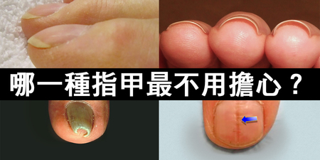 別讓「指甲」成為健康的「禍源甲」！「七種指甲異狀」直斷體內的危機病灶！｜每日健康 Health