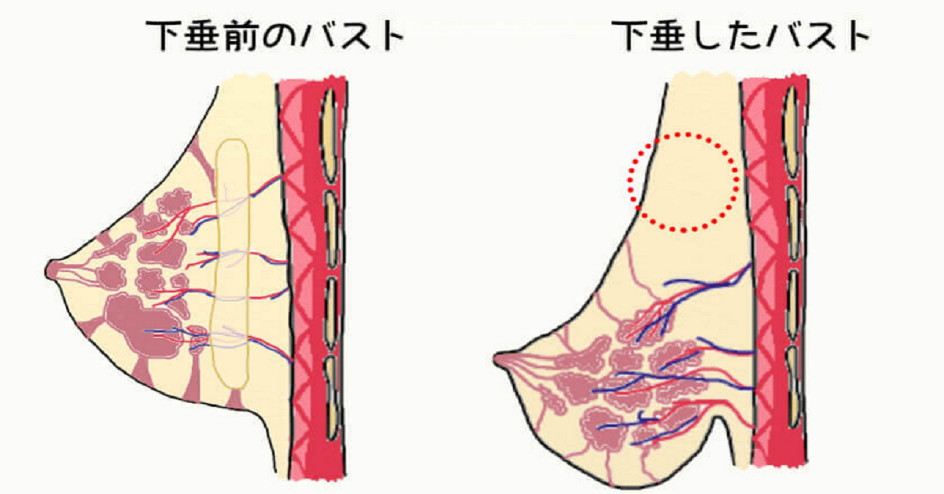婦科醫師親授 搶救 胸部下垂 只要兩招 每天5分鐘 豐胸 遠離鬆弛 找回堅挺雙峰 每日健康health