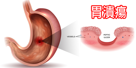 胃酸過多恐導致「胃潰瘍」！「鹼性飲食法」：8吃、12不吃，平衡胃酸很有用！