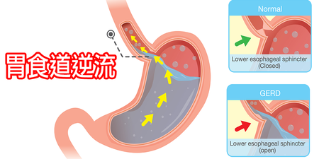 火燒心？打酸嗝？「胃食道逆流」惹的禍！成因、症狀一秒讀。預防胃酸逆流有「12妙招」！