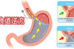 火燒心？打酸嗝？「胃食道逆流」惹的禍！成因、症狀一秒讀。預防胃酸逆流有「12妙招」！