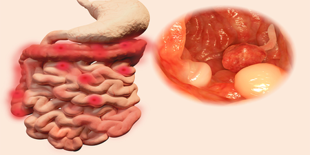 「大腸癌」連續八年蟬聯十大癌症之首！吃這「護腸6寶」，罹癌率大降25%！