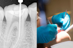 牙醫師極力打破的「根管治療」四迷思！公開「中、西醫」聯手教導的「護牙大法」！｜每日健康Health