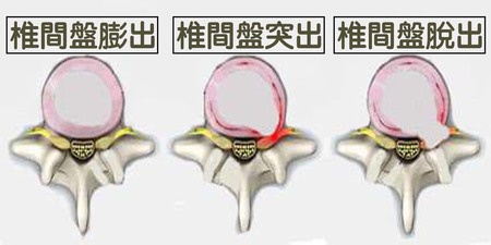 時常「腳麻腰痛」，到底是椎間盤「膨出」、「突出」還是「脫出」？教你一招判定！｜每日健康Health
