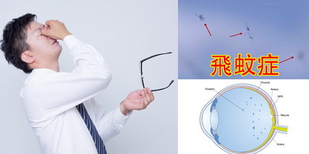 打不死的蚊子【飛蚊症】一發作視力即惡化，兩大「護眼」對策凍齡玻璃體、防退化｜每日健康Health