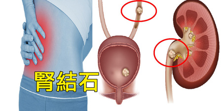 「腎結石」從口入！「6大食物」越吃石頭越多，不處理恐嚴重感染、腎功能受損！｜每日健康Health