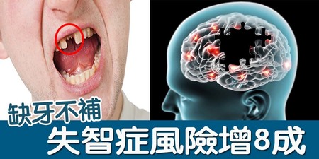 日最新研究：年長者「缺牙」不補，「失智症風險」恐增「80%」！｜每日健康Health
