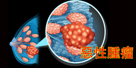 罹患乳癌多三倍！胸部長這樣根本【癌細胞】大本營，防癌守則不可忽視！｜每日健康Health