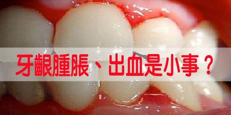 牙齦「腫脹」、「流血」只是火氣大？小心是「肝病」、「血癌」前兆！這種出血最危險！｜每日健康Health