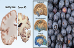 「失智症」是「腦部血流」堵塞造成，多吃這類「暢血水果」，12天讓腦袋重新轉起來｜每日健康 Health