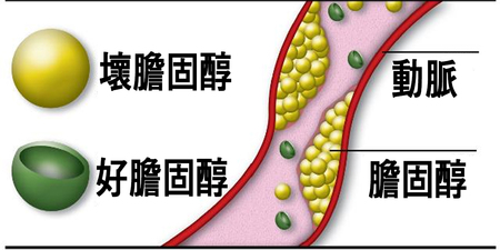瘦子也會「高血脂」！「六撇步」教你逃離血管中風「爆管魔咒」！｜每日健康 Health