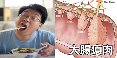 超過這時間睡，「大腸癌」機率增60%！五大「傷腸惡習」養出滿滿的「大腸瘜肉」｜每日健康 Health