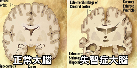 「失智症」蠶食大腦細胞不可逆，這九件事現在就要改｜每日健康 Health