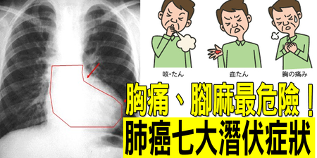 腳麻、胸痛、疲累？「肺癌」存活率不到5%，七大潛伏徵兆最危險｜每日健康 Health