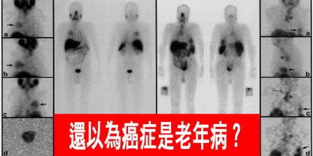 還以為癌症是「老年病」？這四個誤解才是「癌症製造機」！｜每日健康Health