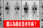 還以為癌症是「老年病」？這四個誤解才是「癌症製造機」！｜每日健康Health