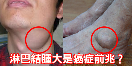 「淋巴結腫大」= 癌症腫瘤？硬不硬、痛不痛竟是關鍵症狀｜每日健康 Health