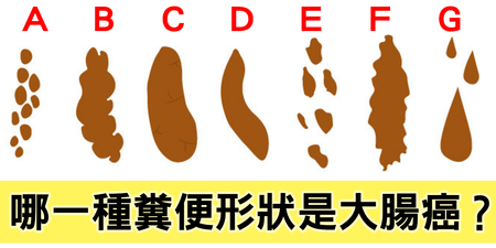 「便祕」、「痔瘡」、「大腸癌」怎麼分？這四種「大便形狀」是腫瘤警訊！｜每日健康 Health