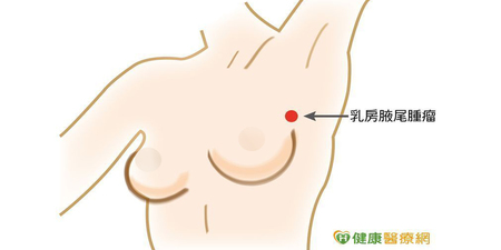 【乳癌死角】難察覺！乳腺末端「乳房腋尾處」，當心癌細胞入住｜每日健康Health