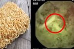 「泡麵」吃下肚子後32小時竟然長這樣！顯微鏡下的「防腐劑真相」｜每日健康 Health