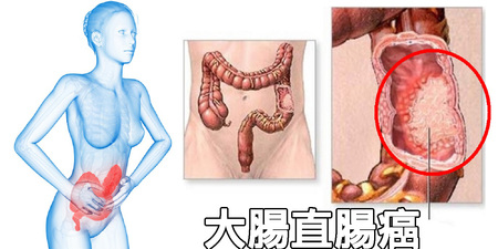 十大癌症「大腸癌」居首位，年奪5000命！風險因子、「9大早期症狀」保命必看｜每日健康Health