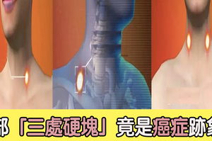 不可大意！「頸部這三處」出現腫塊，竟是癌症跡象？｜每日健康Health