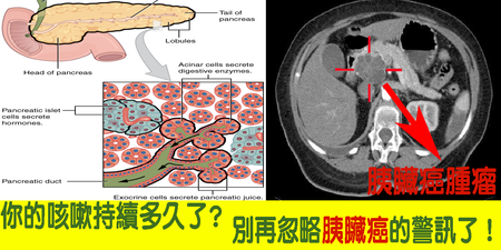 「久咳」不止以為是感冒？癌症之王「胰臟癌」的潛在徵兆必須知道！｜每日健康Health