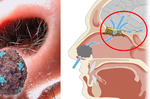 別亂拔「鼻毛」，細菌病毒全找上門，恐引起「腦膜炎」！｜每日健康Health