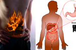 「胃癌」是被「息肉」養大的！偏愛這六種人，「四十歲以上」高危險需警覺！｜每日健康Health