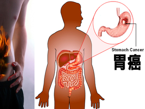 「胃癌」是被「息肉」養大的！偏愛這六種人，「四十歲以上」高危險需警覺！｜每日健康Health