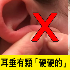 耳垂有顆「硬硬的」竟不是痘痘？硬擠「粉瘤」的可怕後遺症｜每日健康Health
