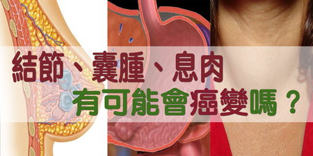 「結節、囊腫、息肉」有可能會癌變嗎？專家：三種外觀要當心｜每日健康Health