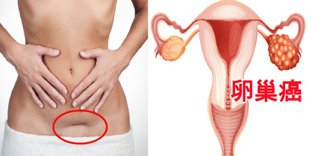 晚期「卵巢癌」存活率僅有11%！女人必吃「8大食物」搶先預防，罹癌率大降75%｜每日健康 Health