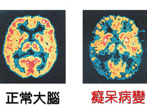 一同擊退「阿茲海默症」！生活中就可輕鬆執行，這【４件事】讓你迅速活化大腦｜每日健康 Health