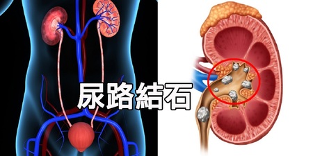 「尿路結石」要限鈣、禁食草酸？答案太驚人！醫師親授「5大抗石法則」杜絕復發｜每日健康Health