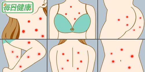 身體「紅疹」暗藏危機！一張圖秒懂身體哪裡有毛病，胸口、背部出疹子最危險｜每日健康
