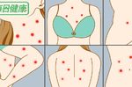 身體「紅疹」暗藏危機！一張圖秒懂身體哪裡有毛病，胸口、背部出疹子最危險｜每日健康
