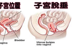 「下半身」紅腫、有灼熱感？30歲以上女性當心「四原因」引爆「子宮脫垂」｜每日健康Health