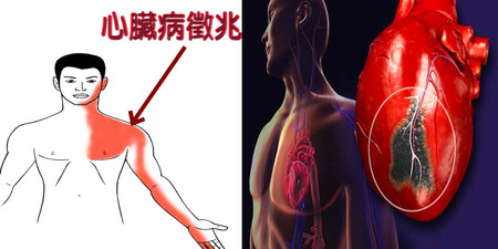 左臂「重」如千斤頂、疼痛刺骨竟是「心臟病」惹禍？3跡象埋下「心肌梗塞」未爆彈，一秒也別輕忽｜每日健康Health